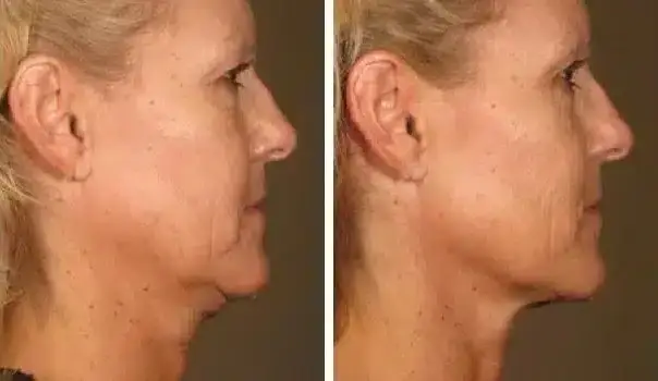 ultherapy15mm 0297j k before 90daysafter full