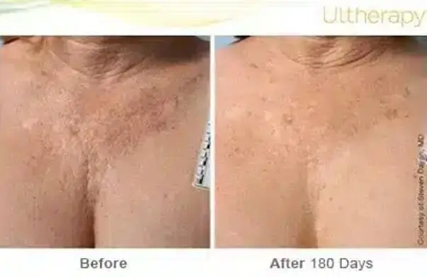 ultherapy 018p d beforeandafter