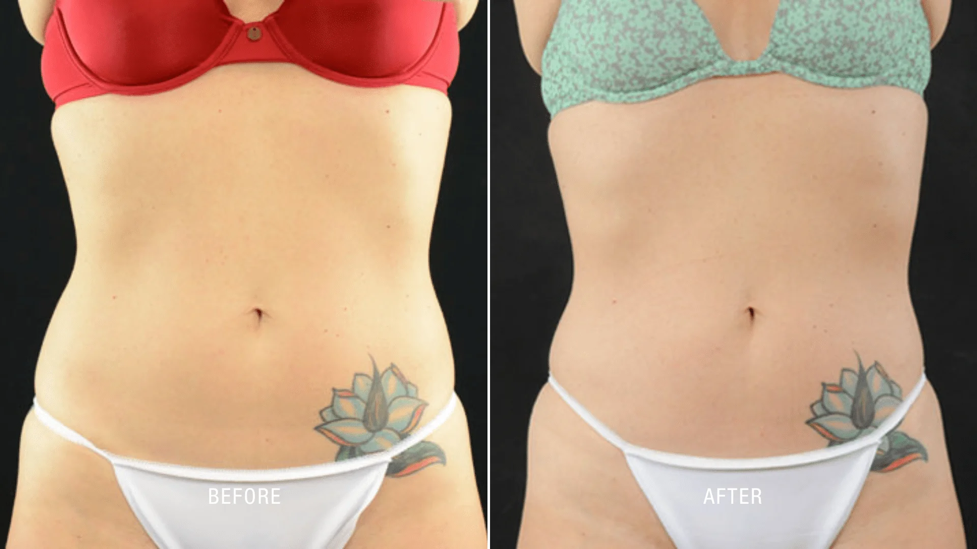 EON Laser Before and After Results How to Secure Optimal Fat Reduction
