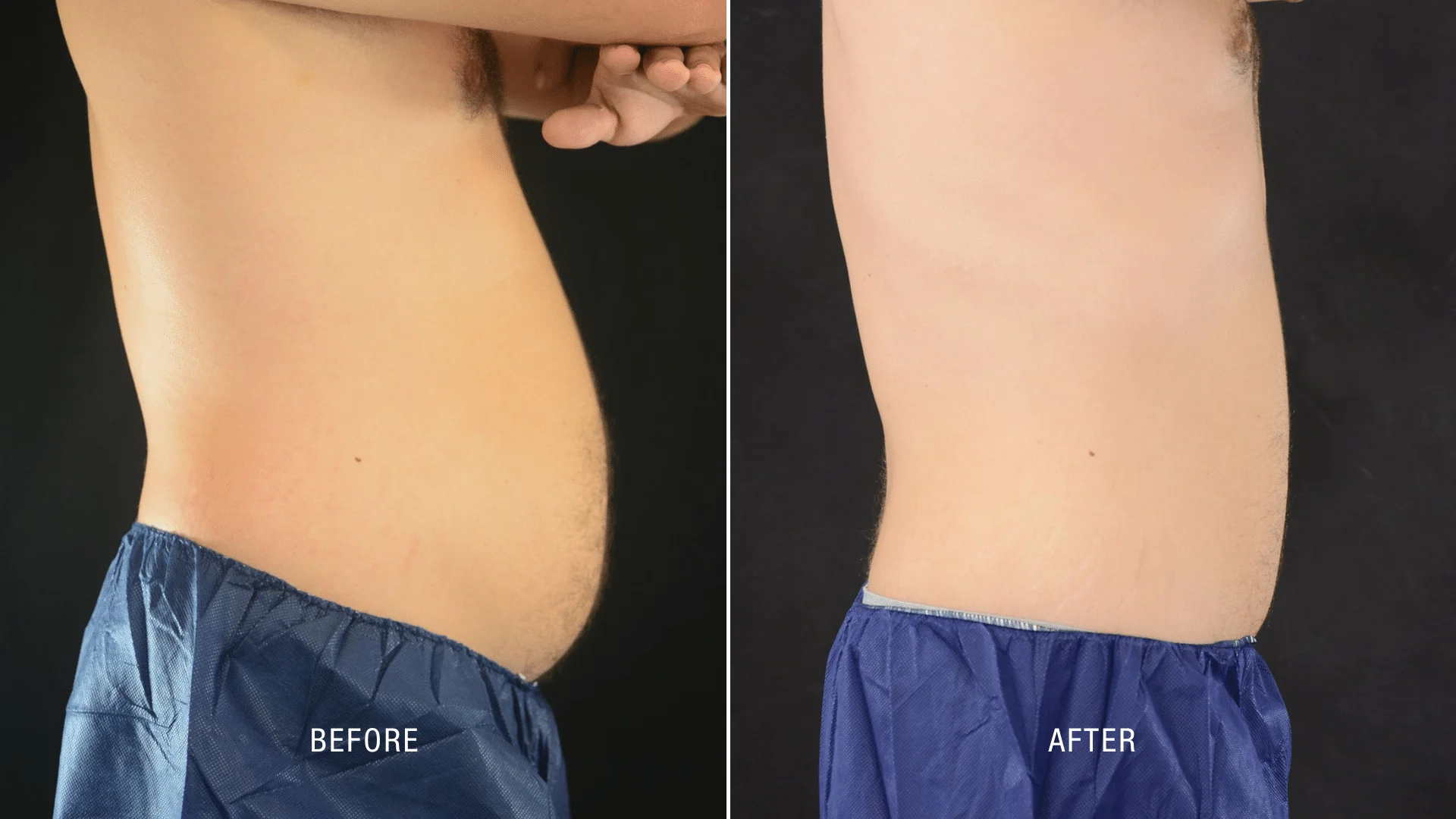 EON Laser Before and After Results How to Secure Optimal Fat Reduction