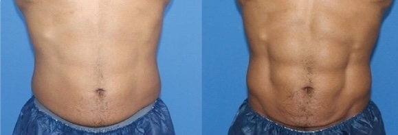 truFlex Before and After