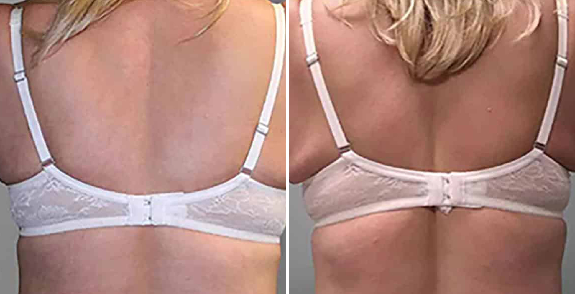 Venus Freeze Before & After