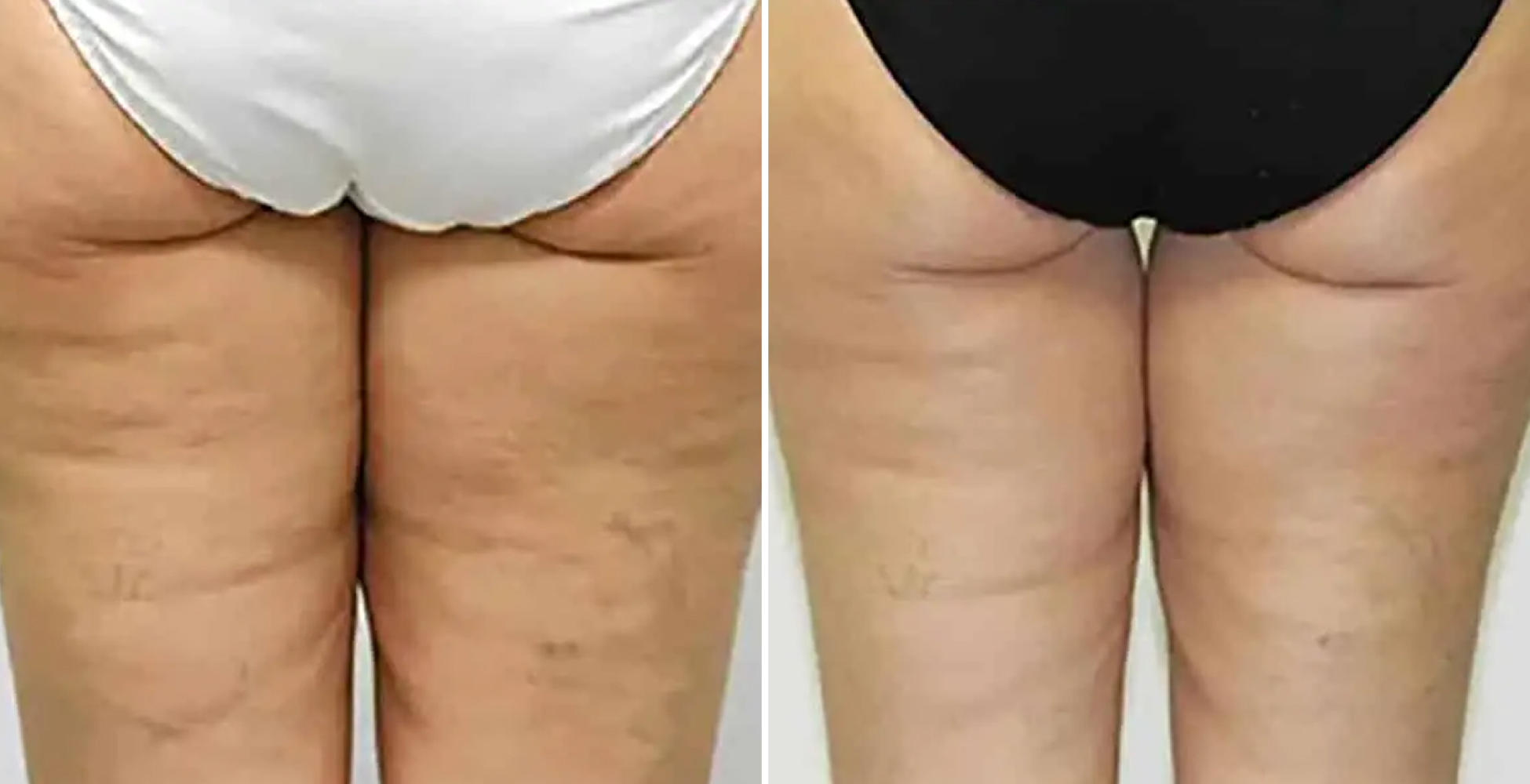 Venus Freeze Before & After