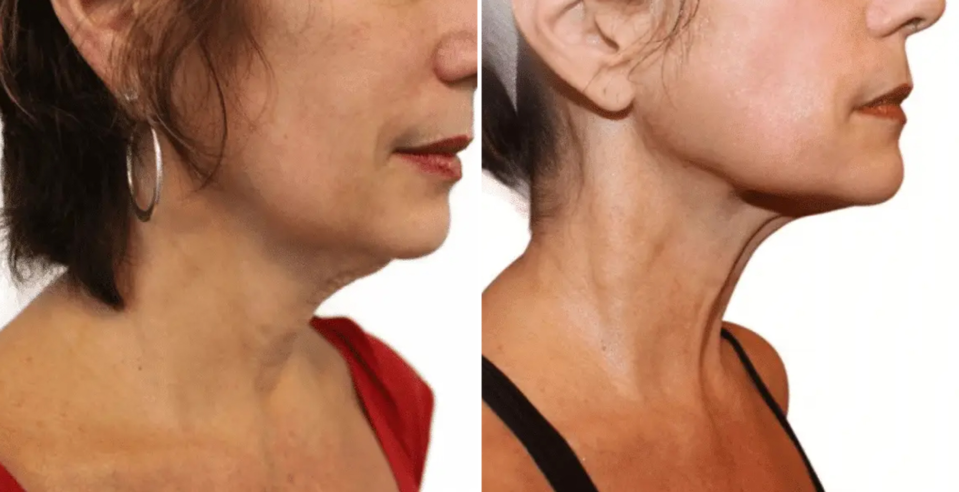 Venus Freeze Before & After