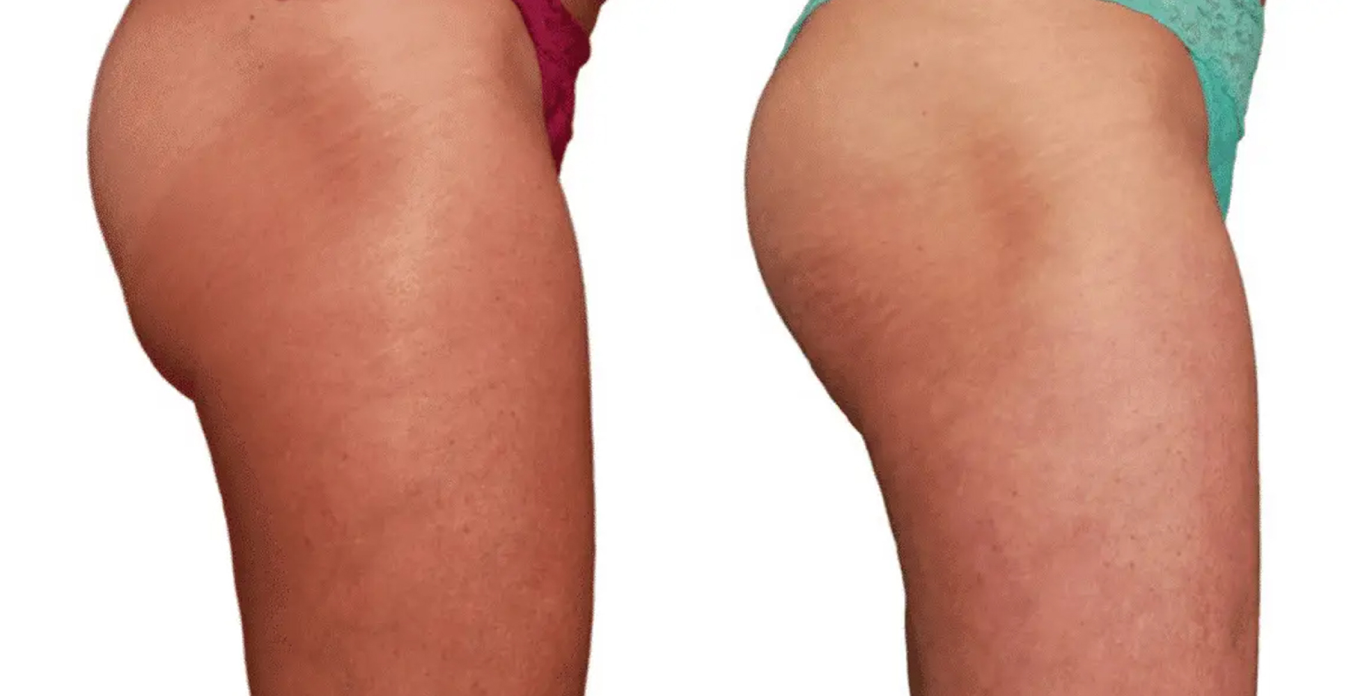 Venus Freeze Before & After