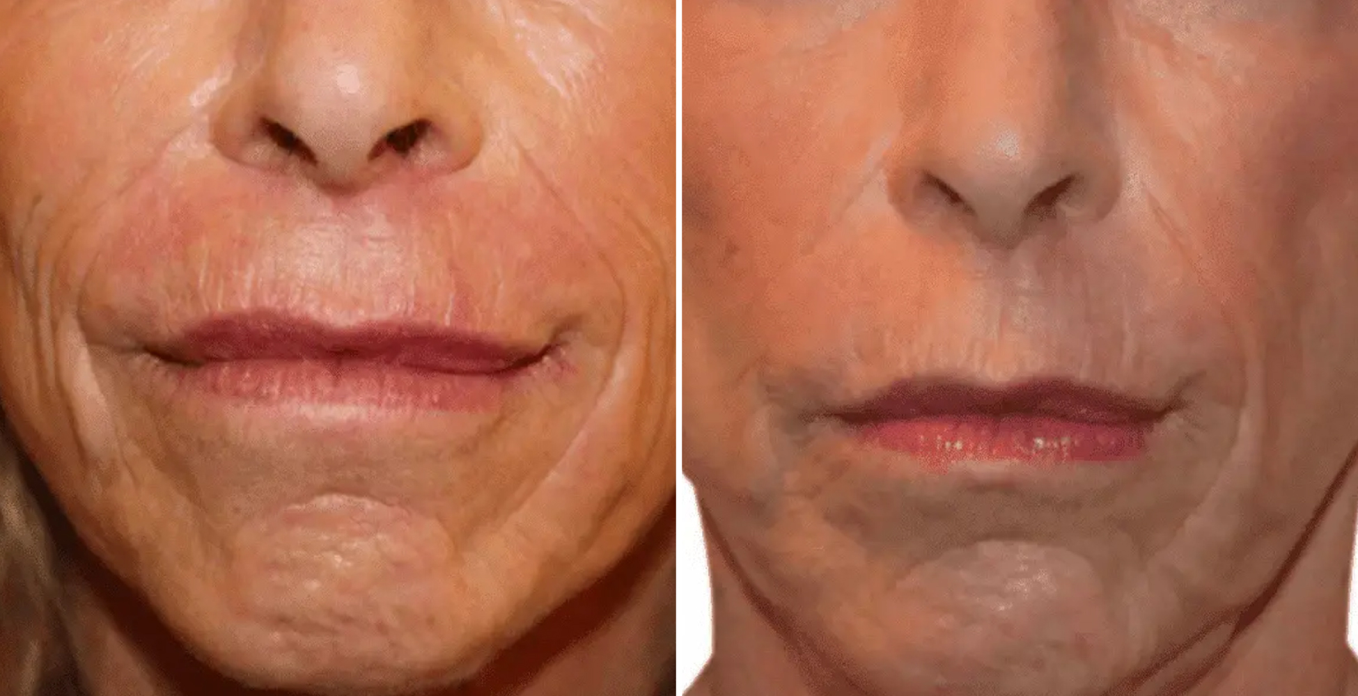 Venus Freeze Before & After