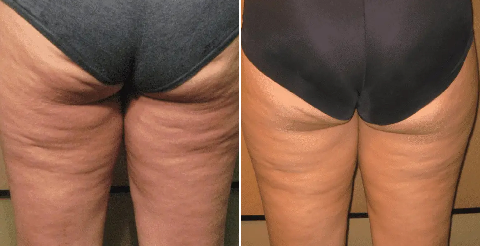 Venus Freeze Before & After