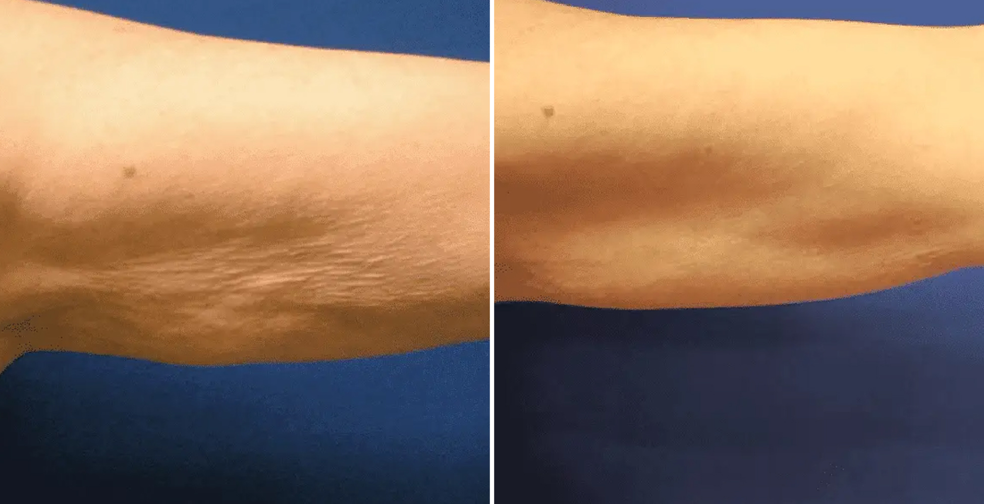 Venus Freeze Before & After