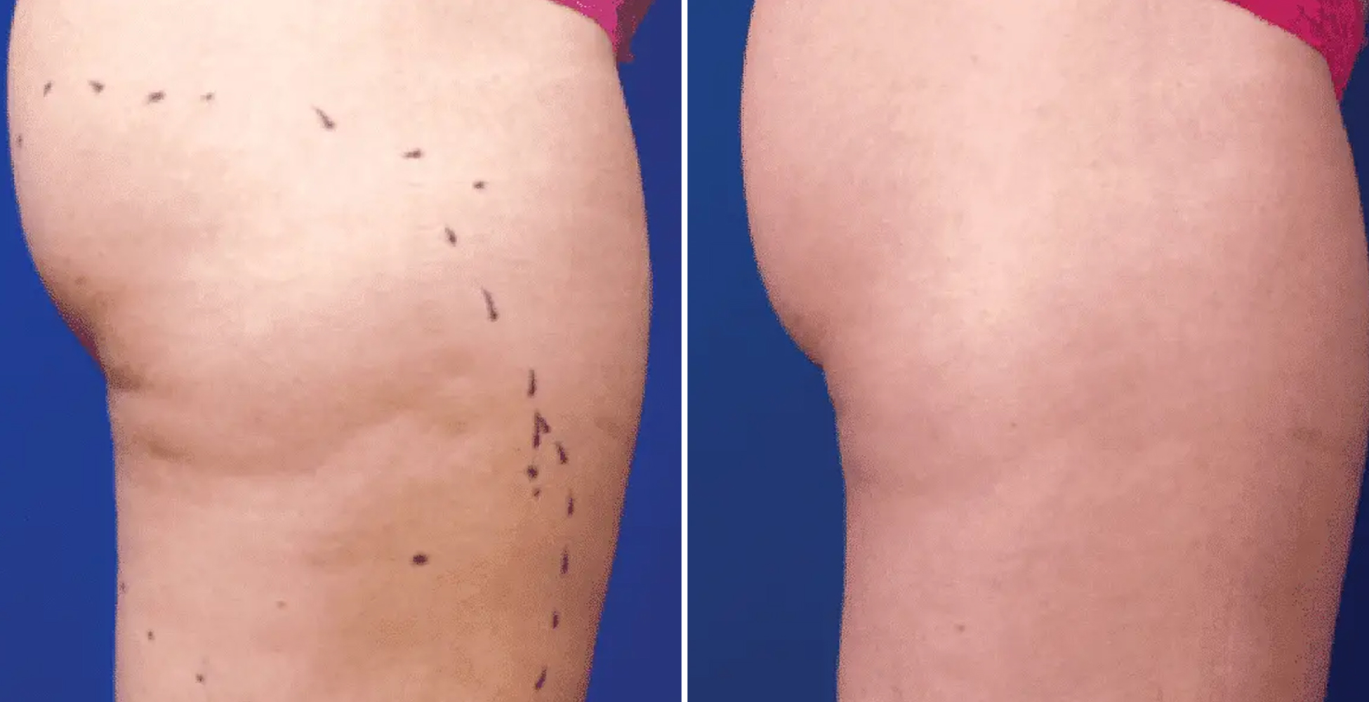 Venus Freeze Before & After