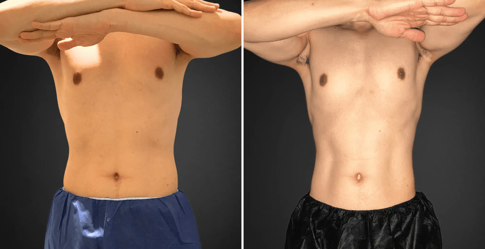 Emsculpt NEO Before & After