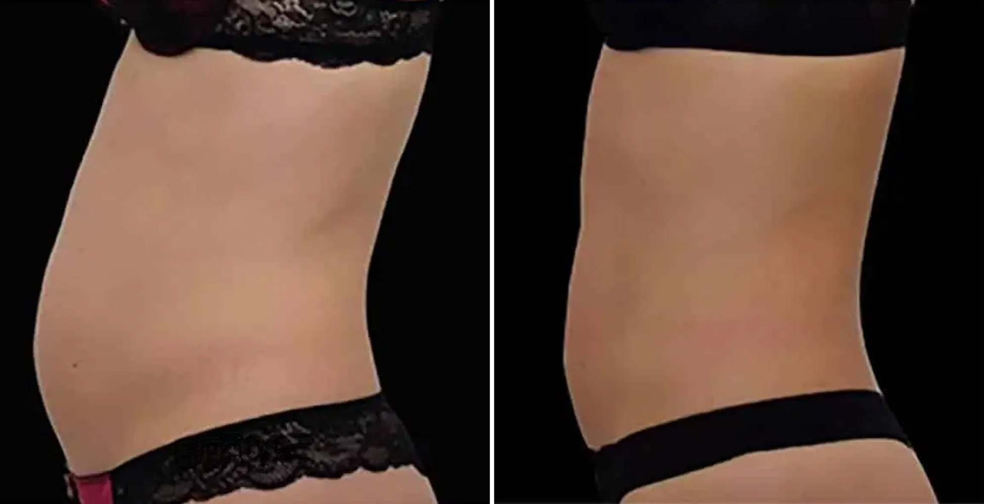 Emsculpt NEO Before & After
