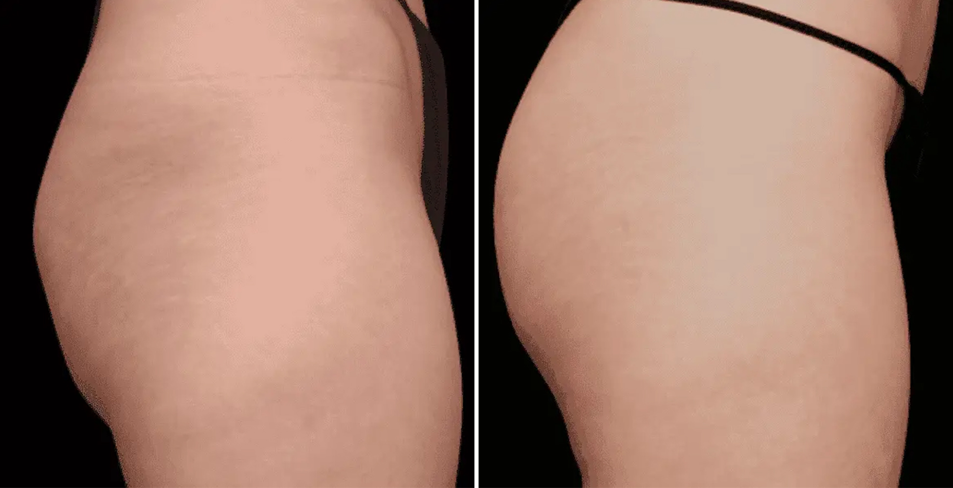 Emsculpt NEO Before & After