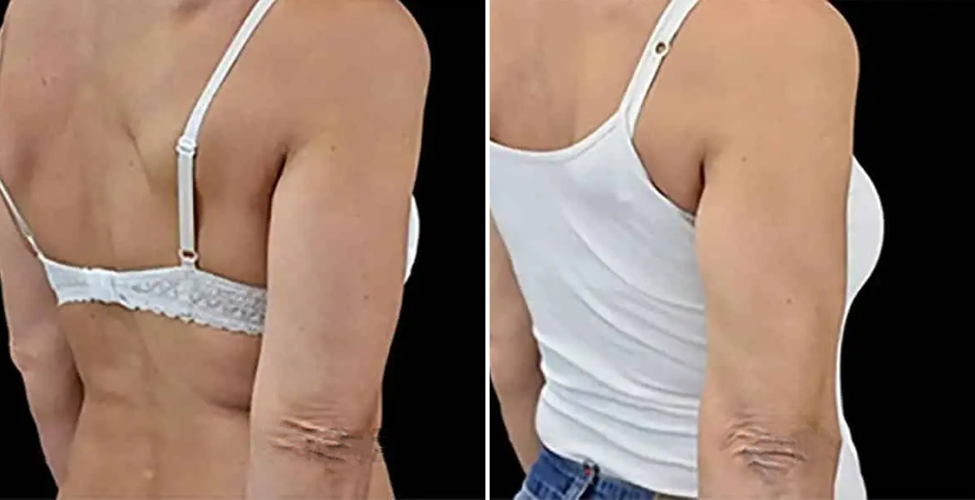 Emsculpt NEO Before & After