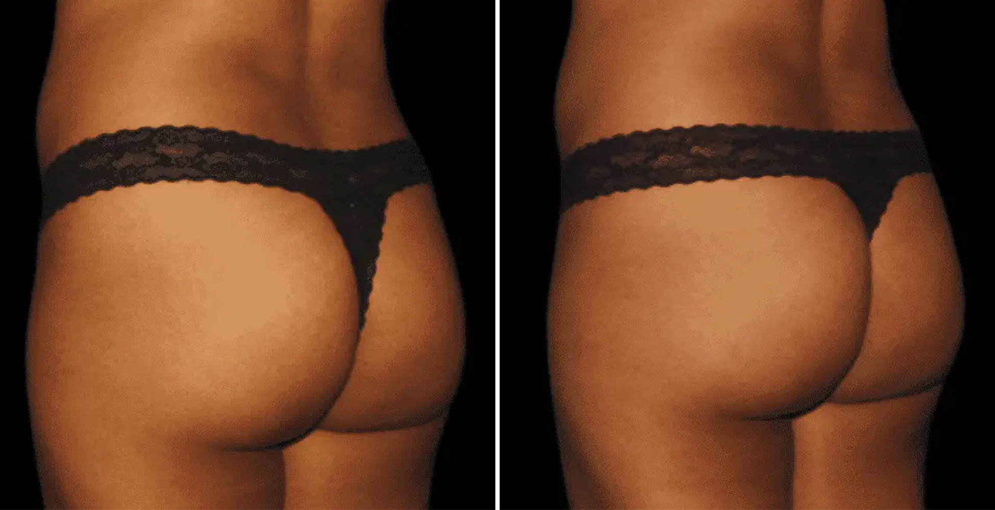 Emsculpt NEO Before & After