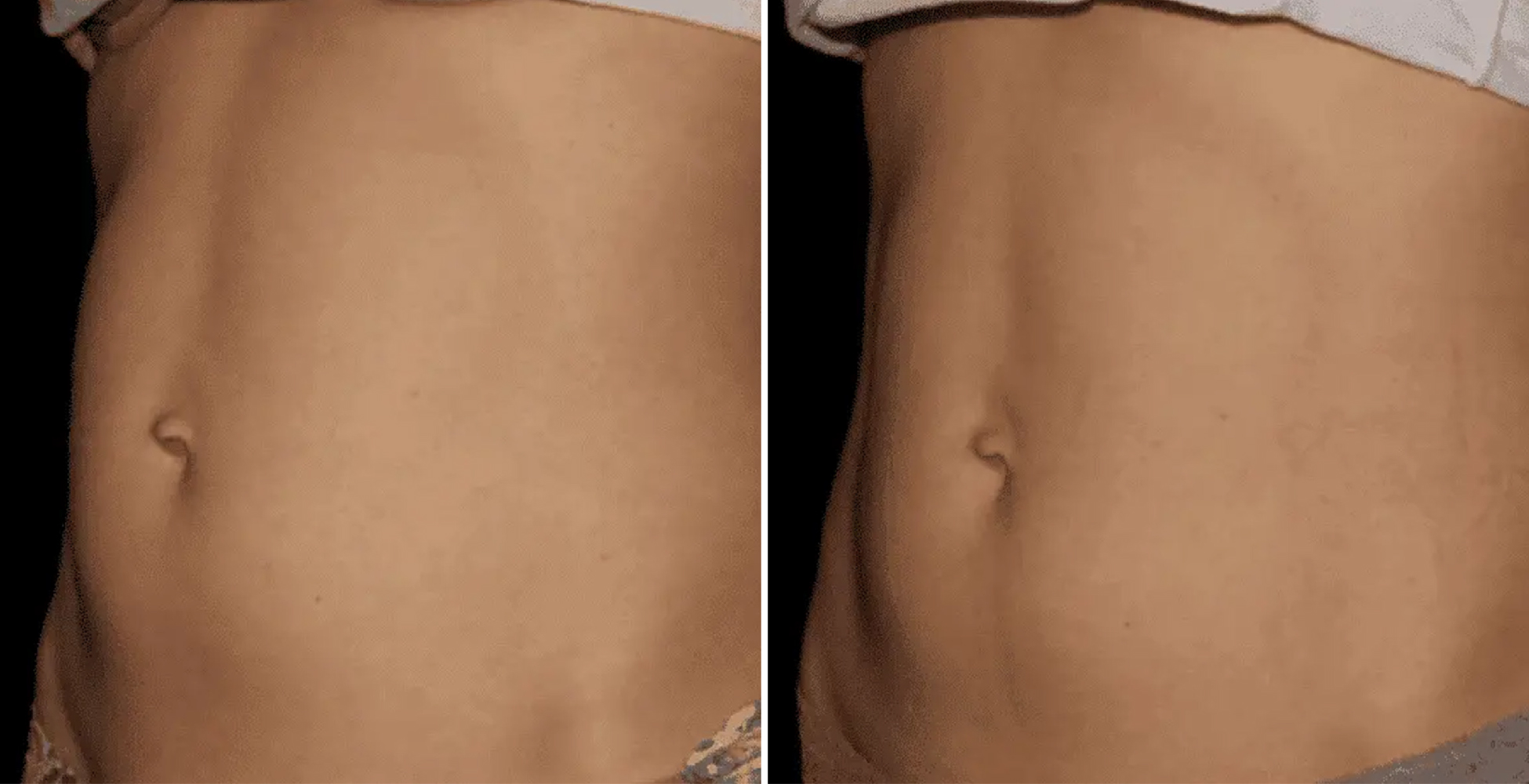 Emsculpt NEO Before & After