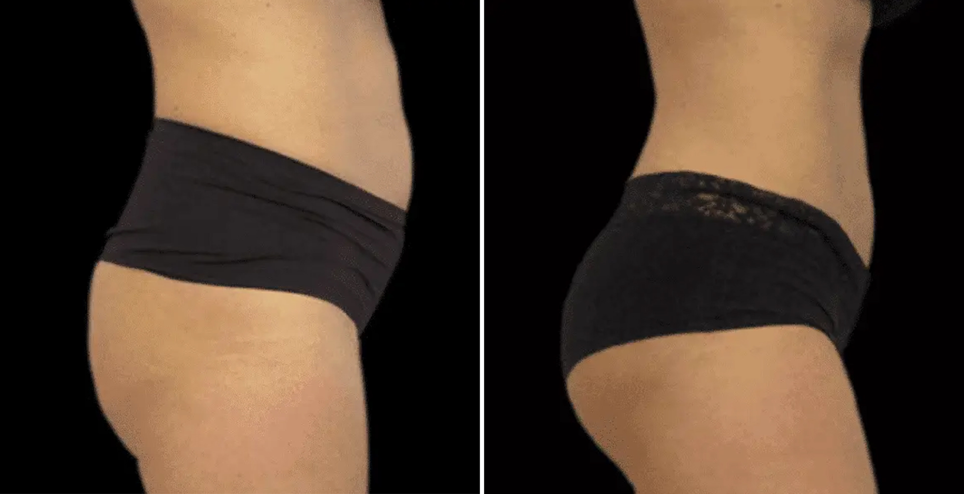 Emsculpt NEO Before & After