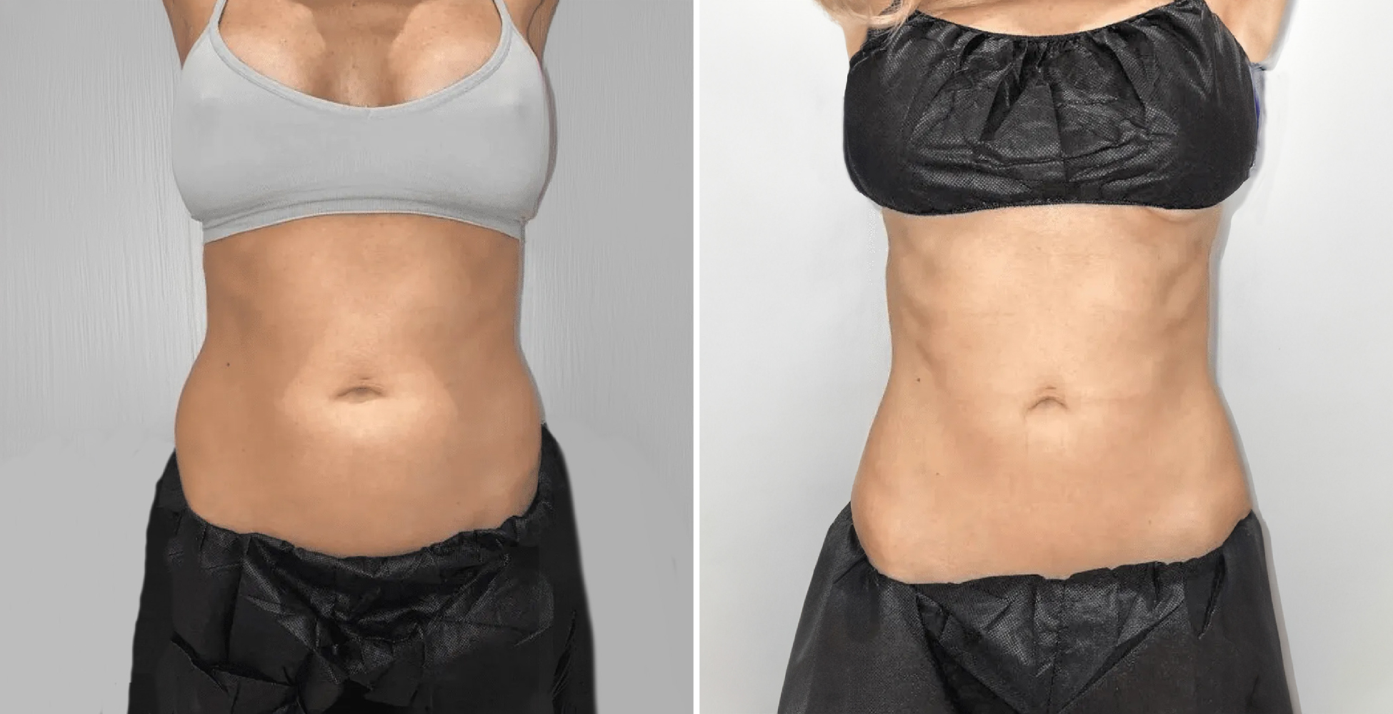 Emsculpt NEO Before & After