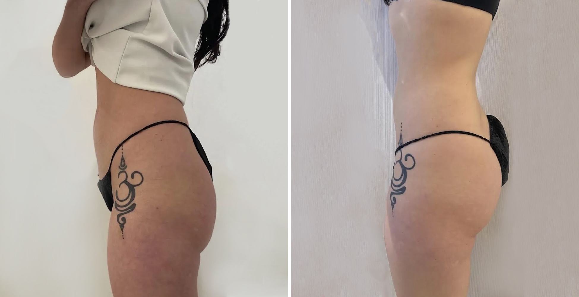 Emsculpt NEO Before & After