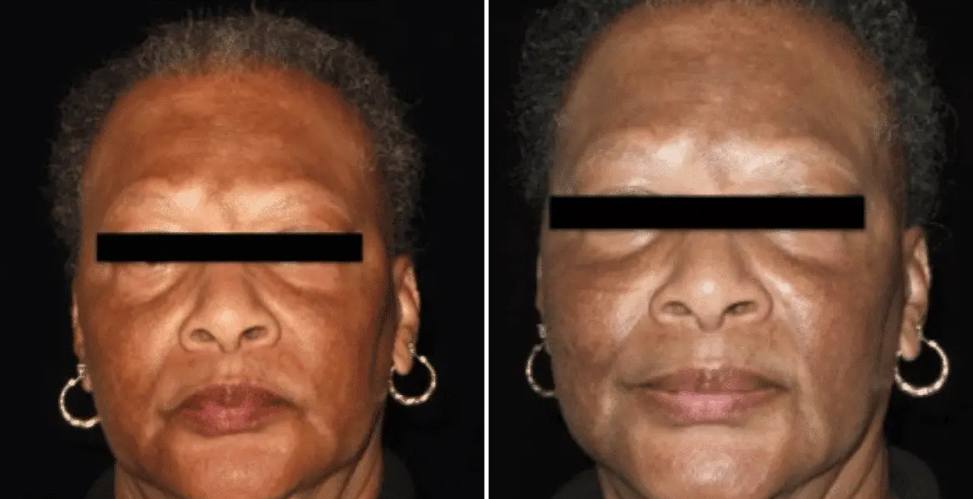 Aquagold Before & After