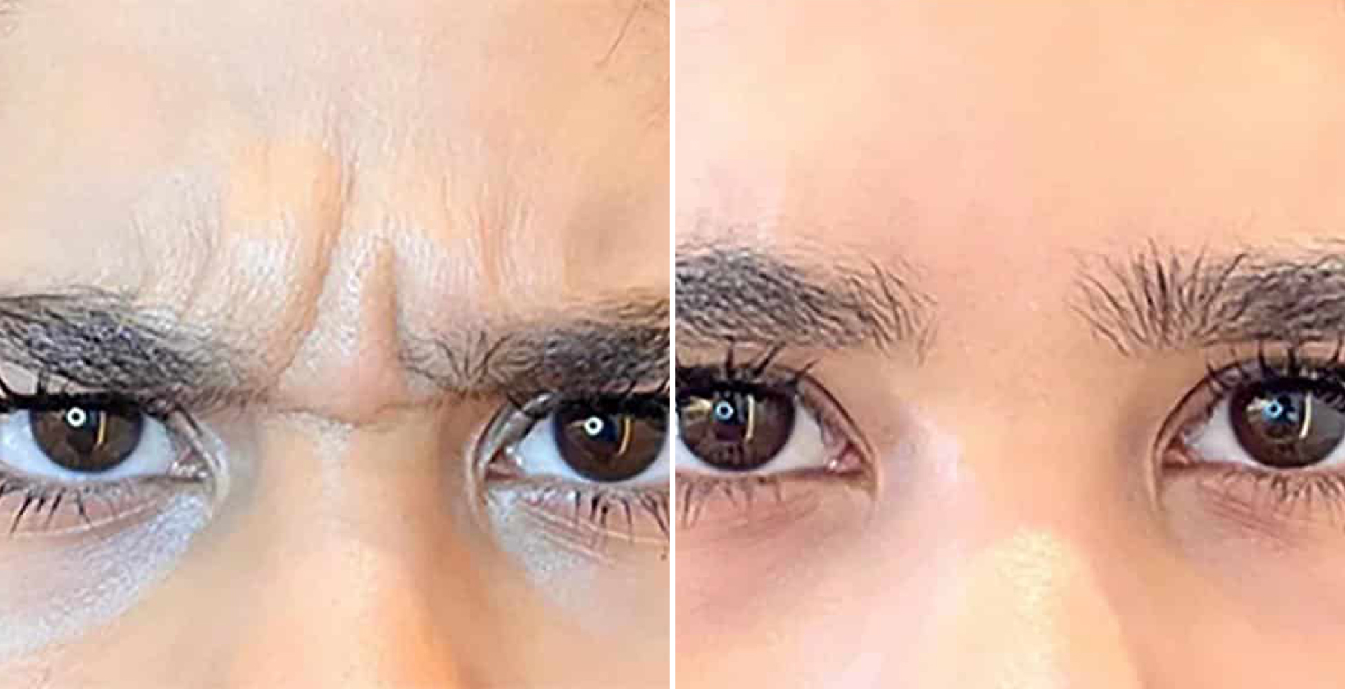 Botox Before & After