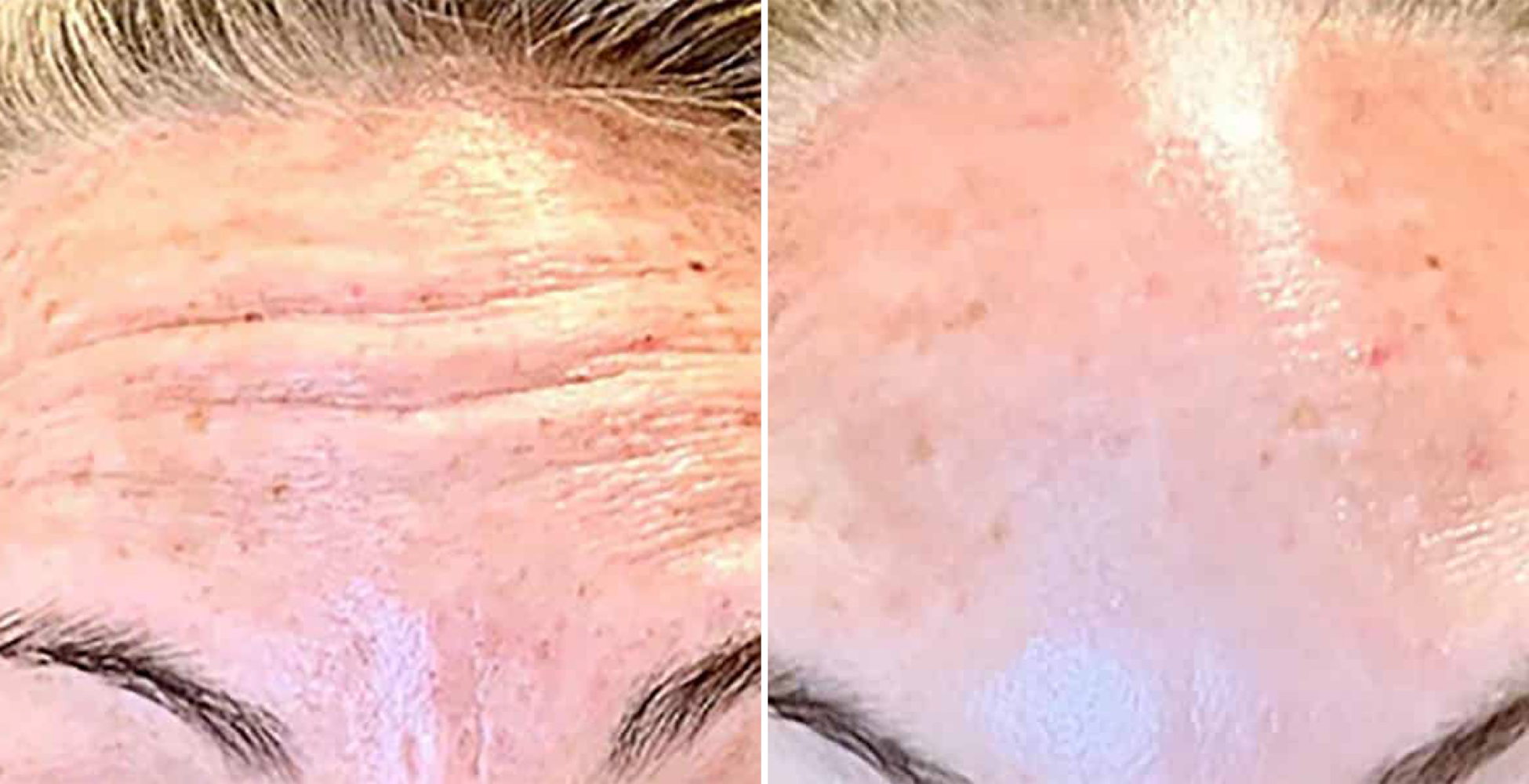 Botox Before & After