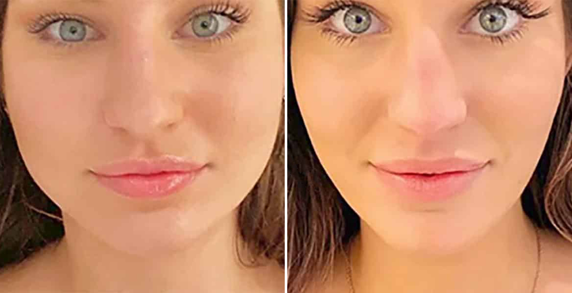 Botox Before & After