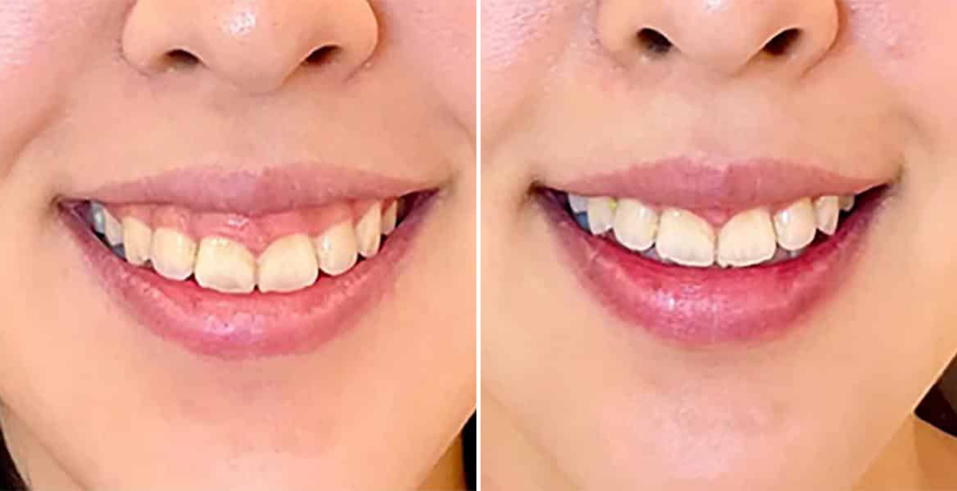 Botox Before & After