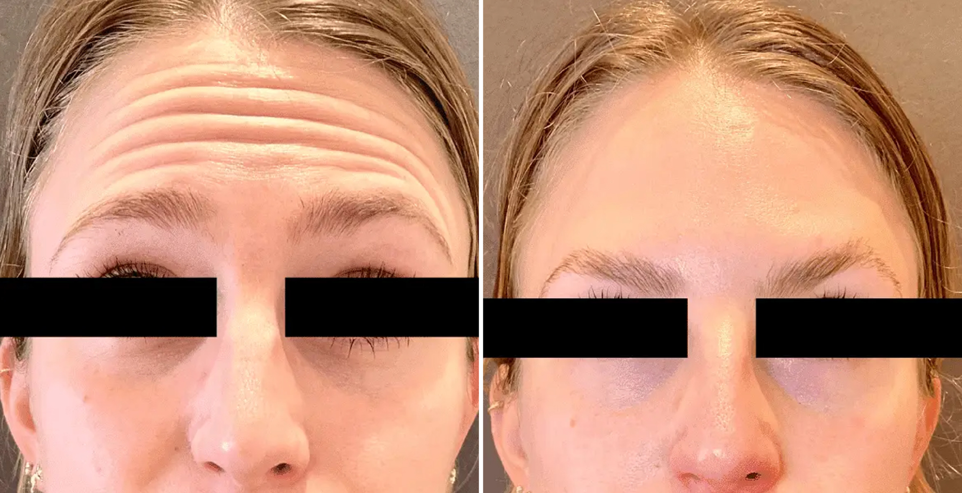 Botox Before & After