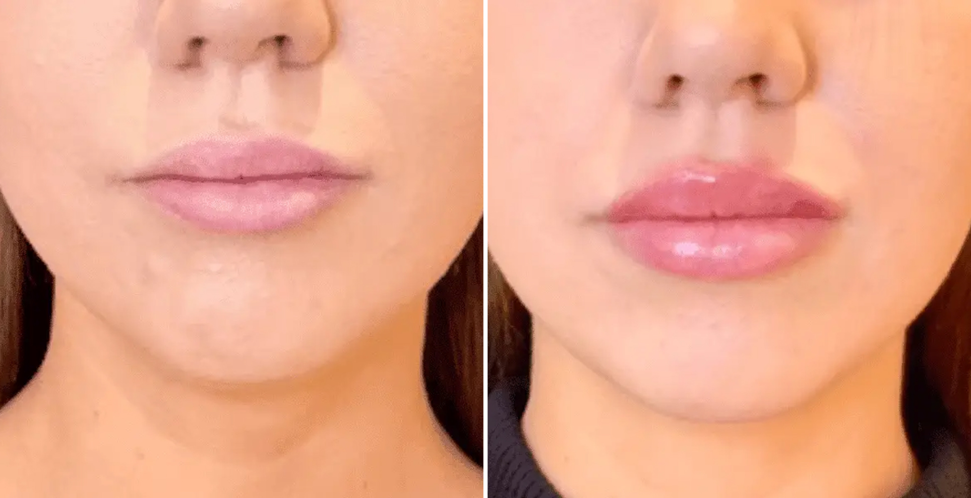 Botox Before & After