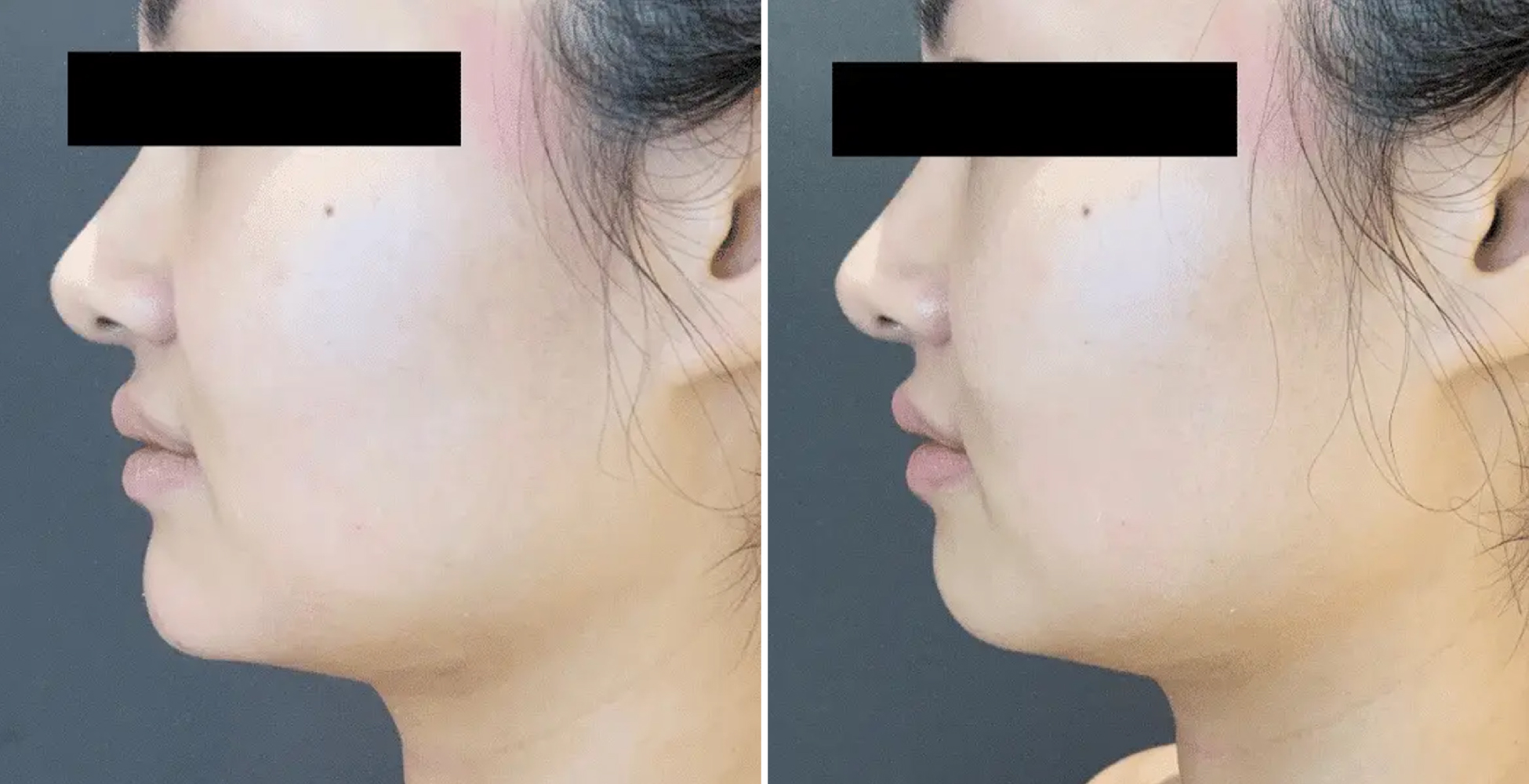 Botox Before & After