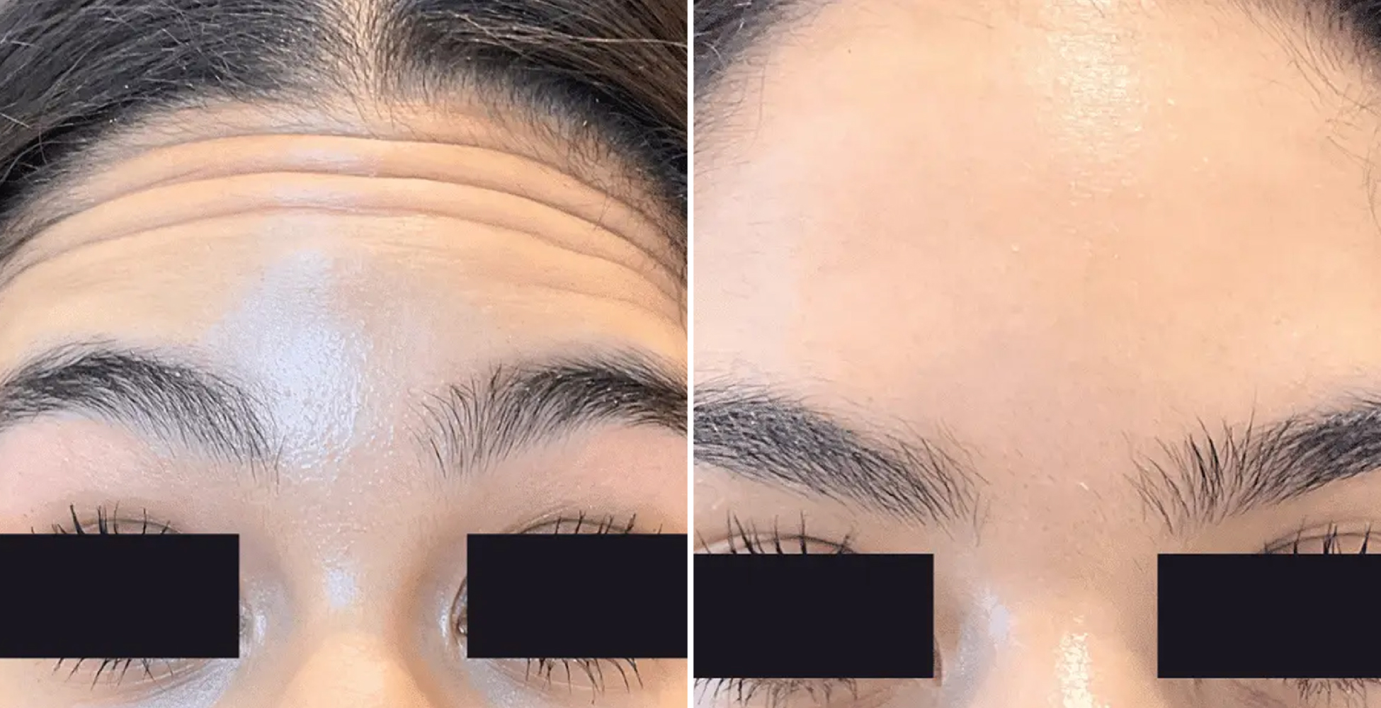 Botox Before & After