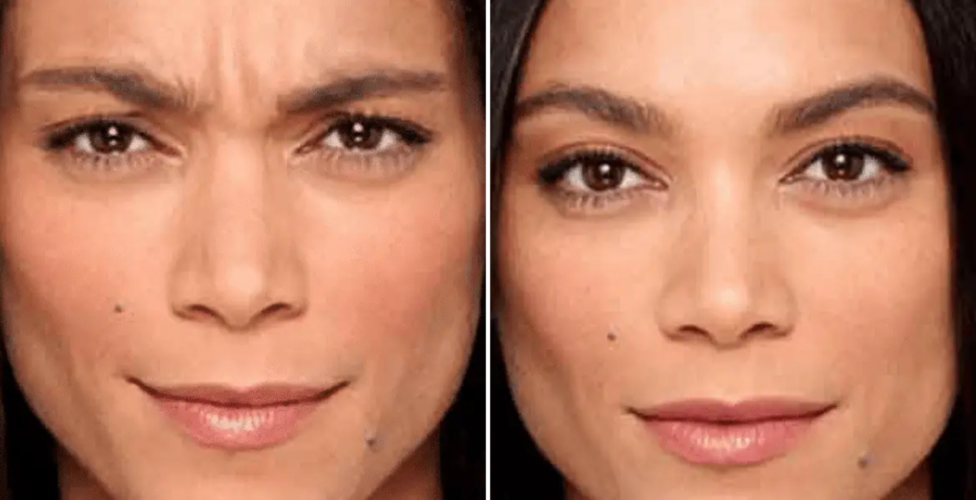 Botox Before & After