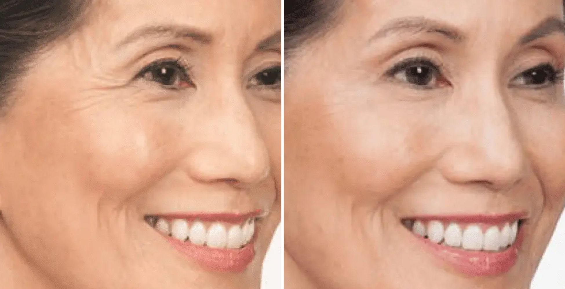 Botox Before & After