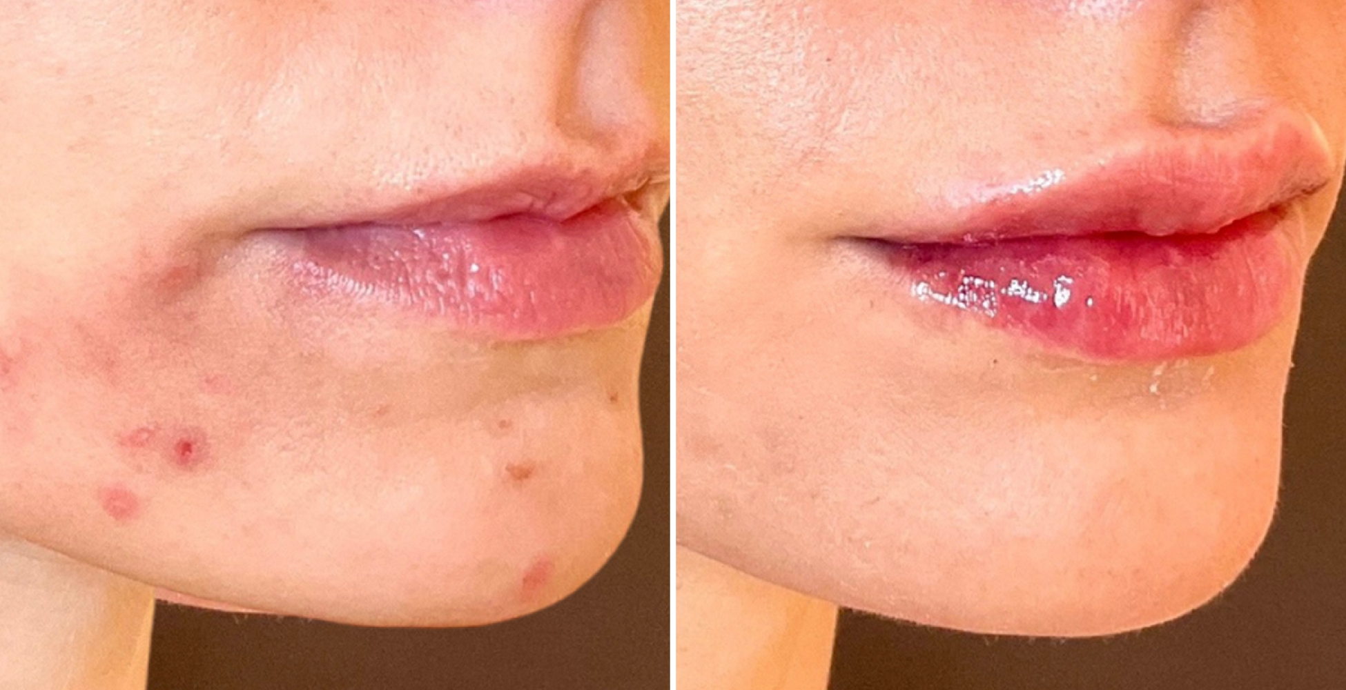 Botox Lip Flip Before After