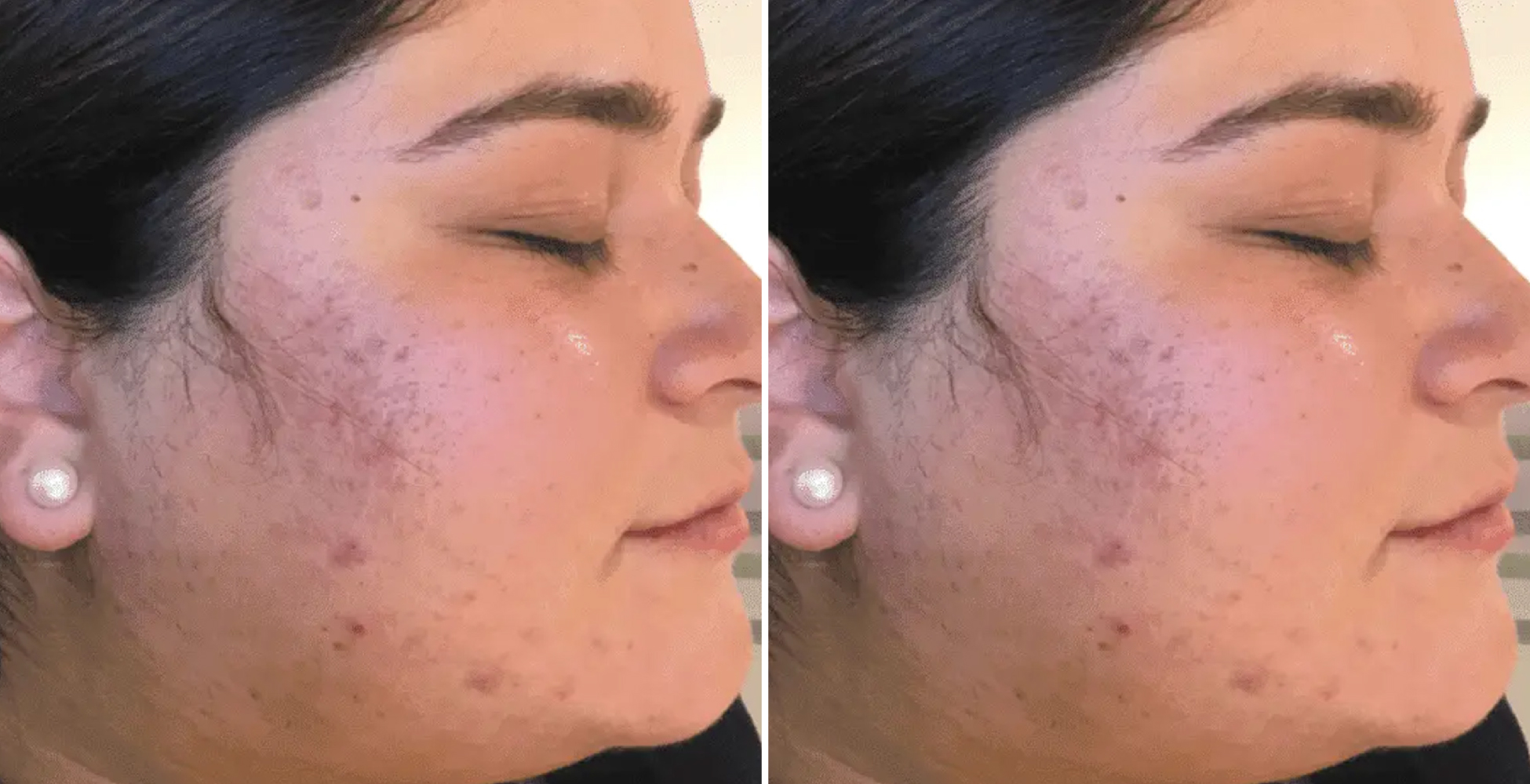 Chemical Peel Before & After