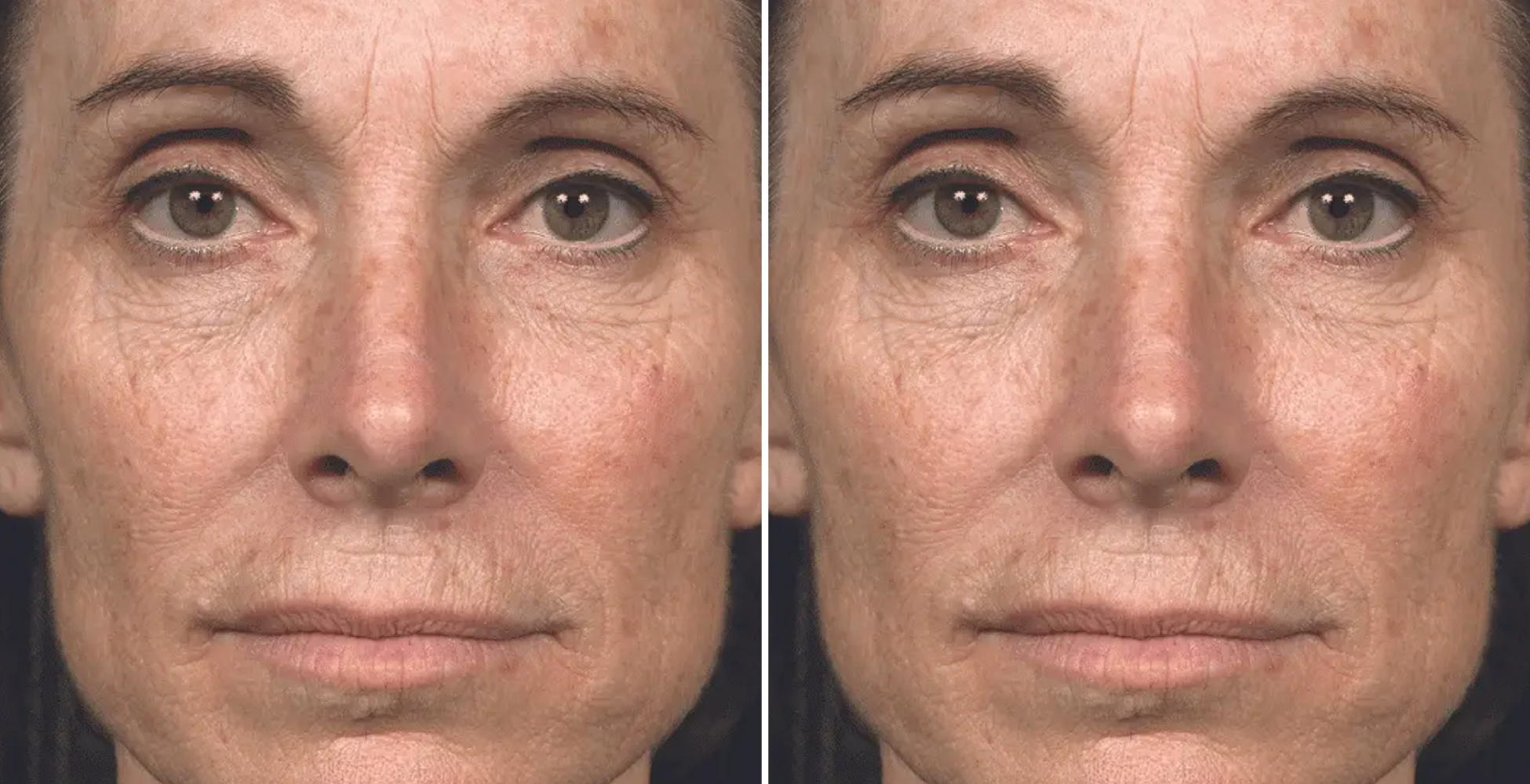 Chemical Peel Before & After