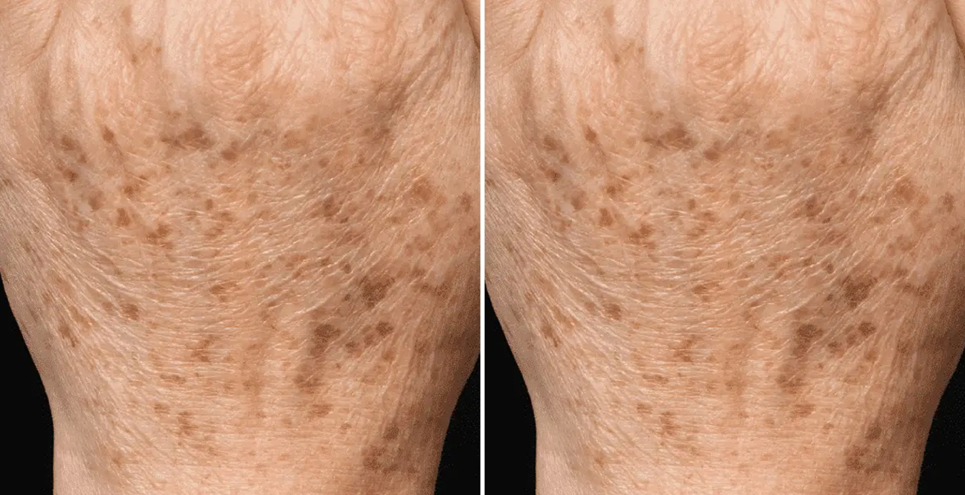 Chemical Peel Before & After
