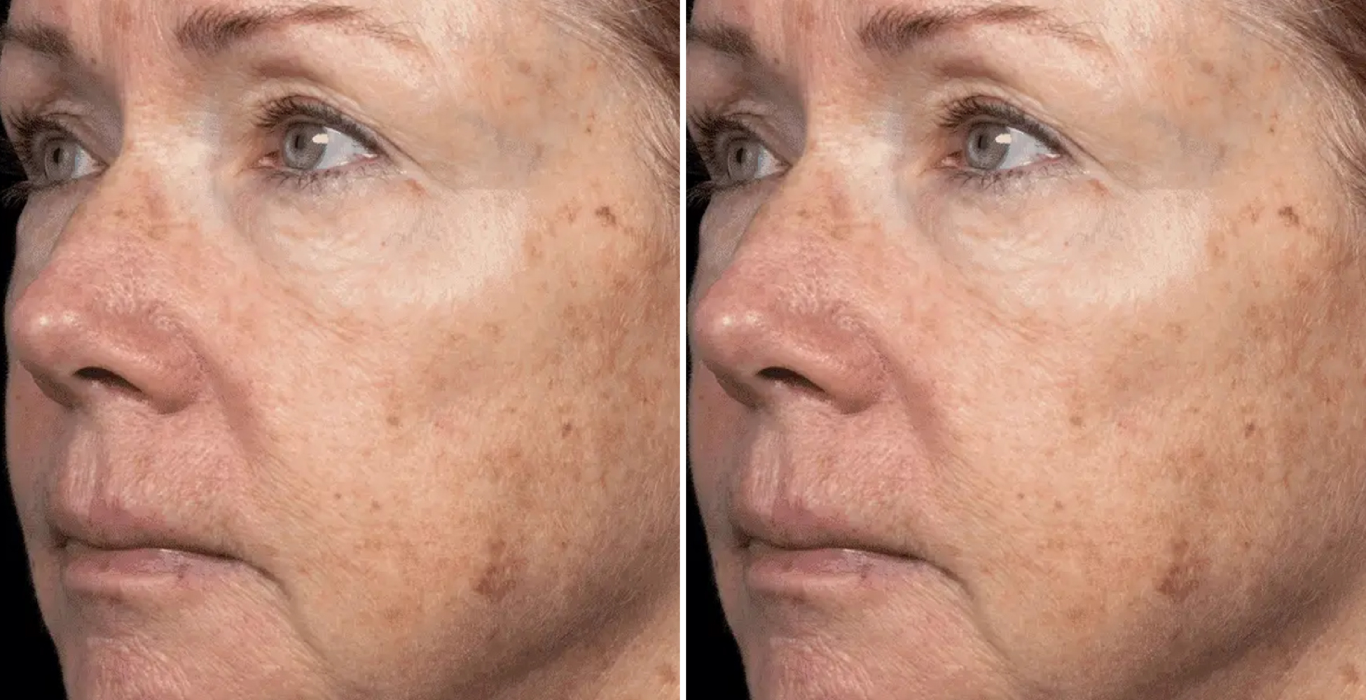 Chemical Peel Before & After