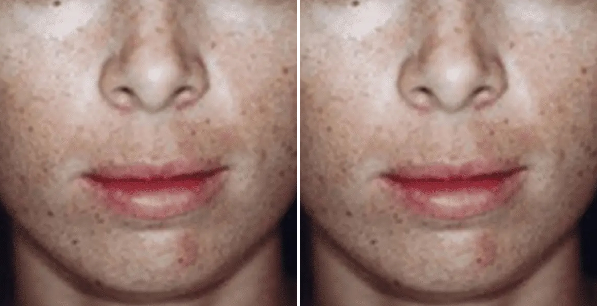 Chemical Peel Before & After