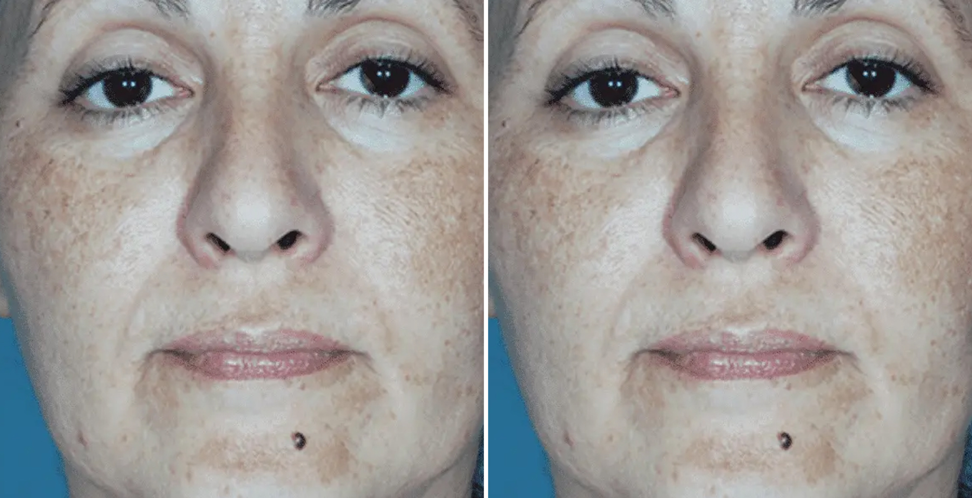 Chemical Peel Before & After
