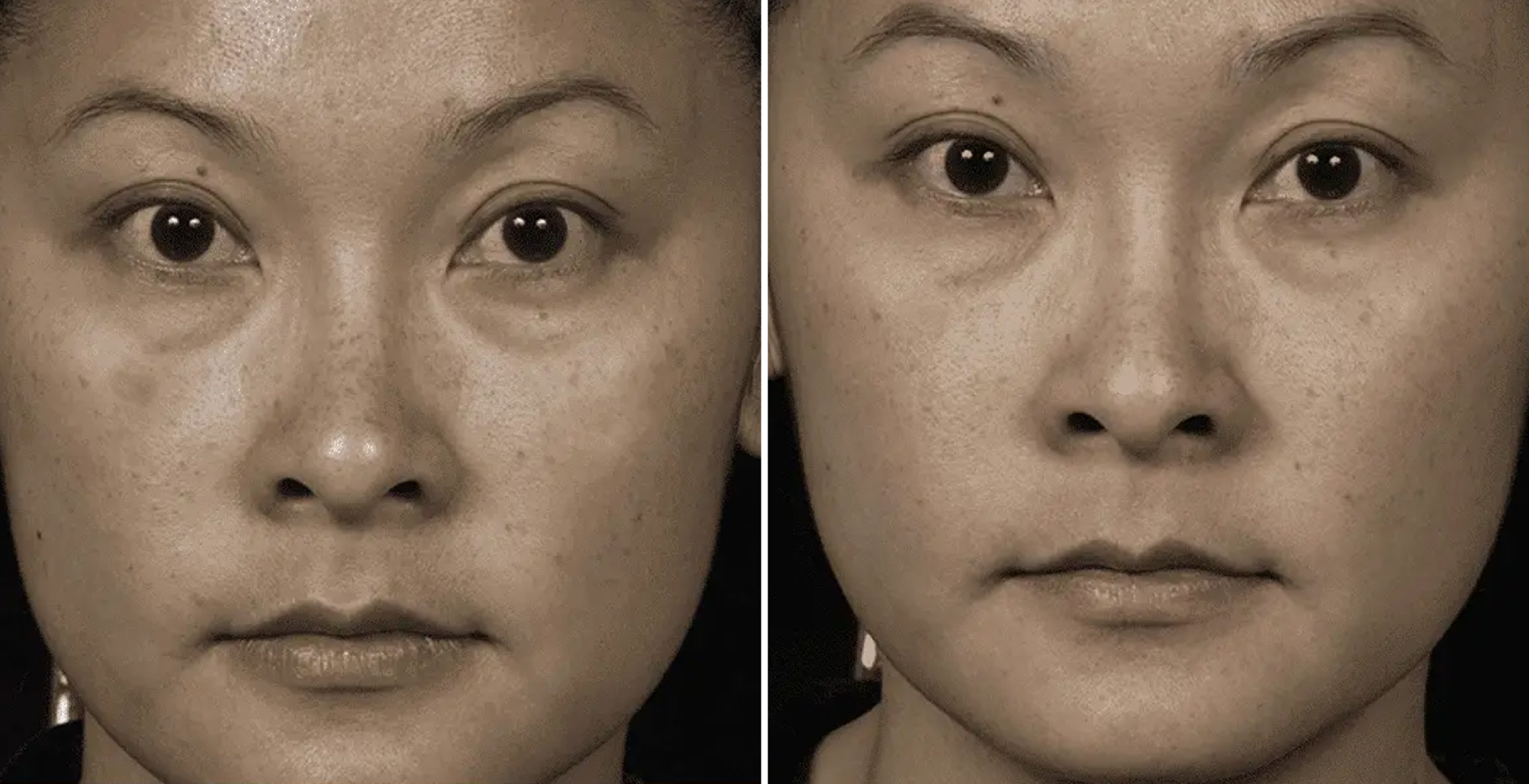 Chemical Peel Before & After