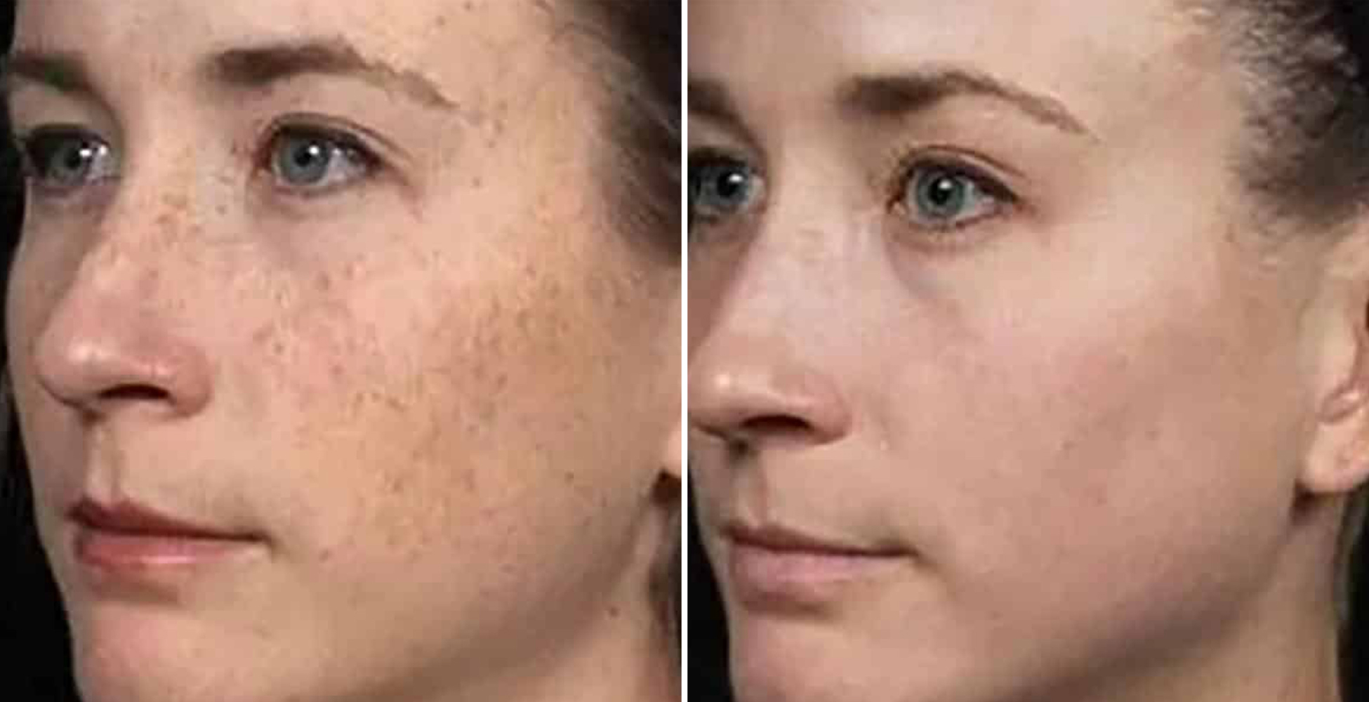 Clear + Brilliant After & Before