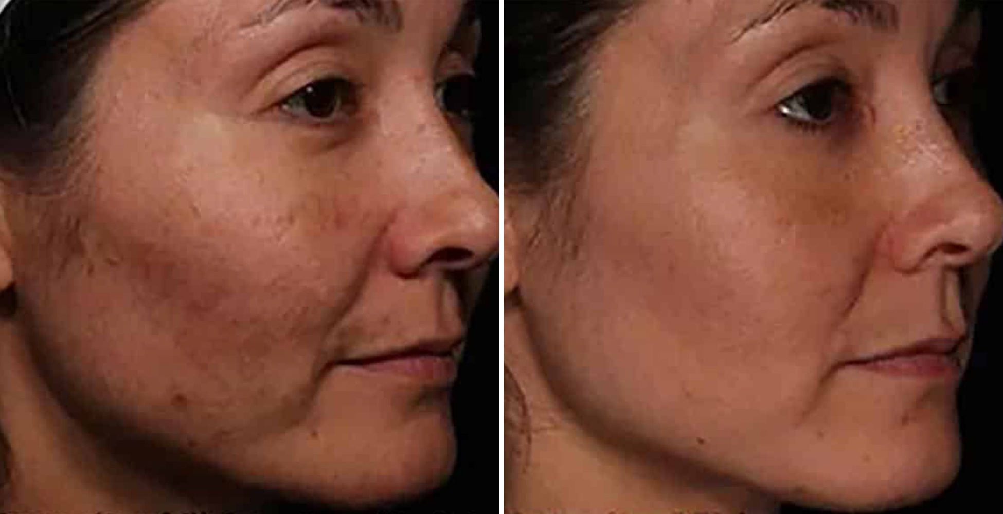 Clear + Brilliant After & Before