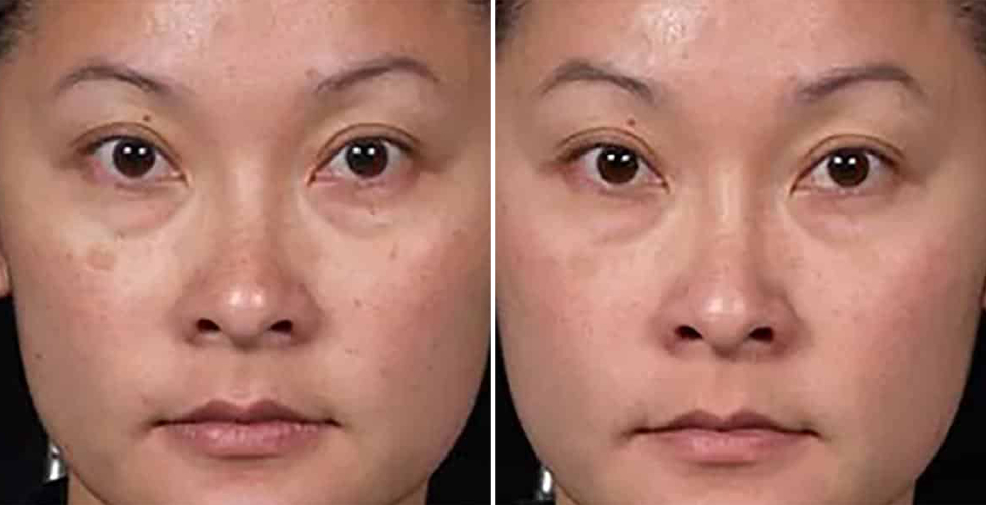 Clear + Brilliant After & Before