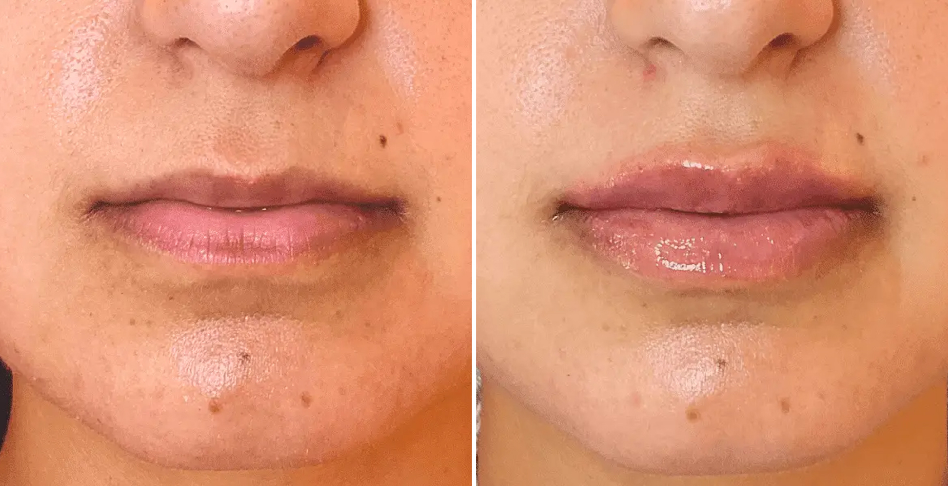 woman's lips before and after lip filler NYC treatment at SKINNEY Medspa