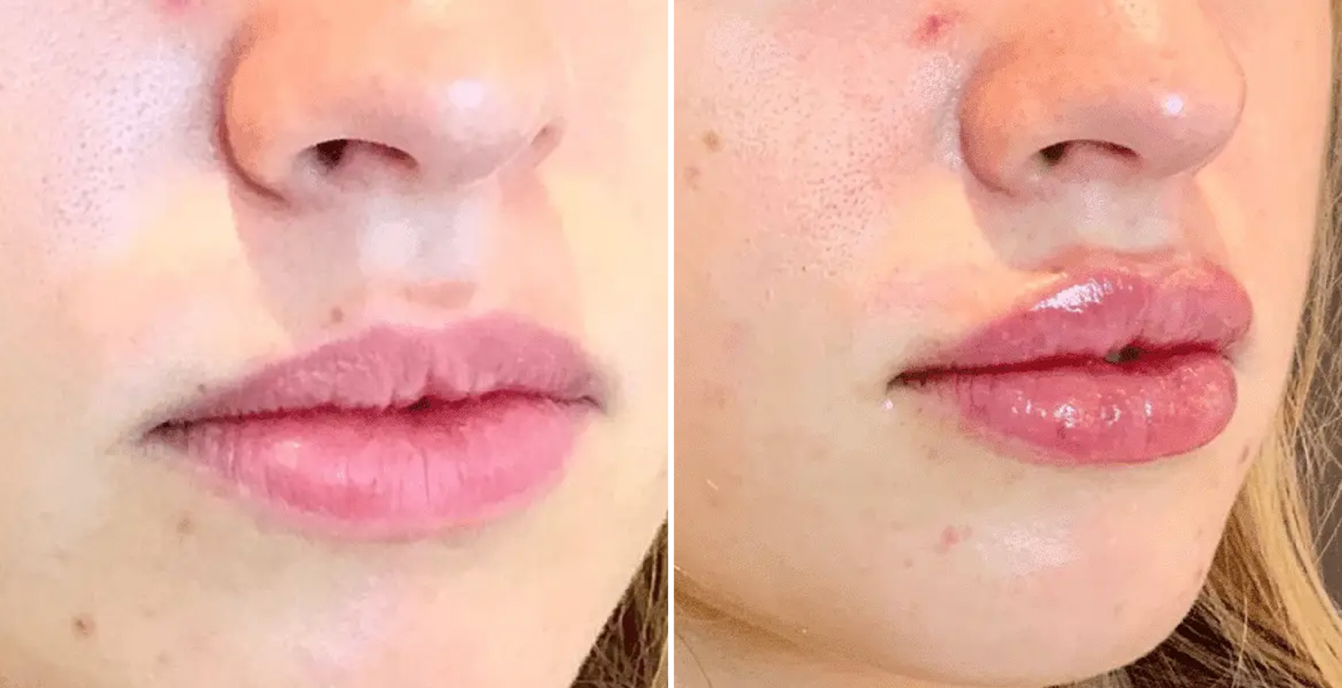 woman's lips before and after lip filler NYC treatment