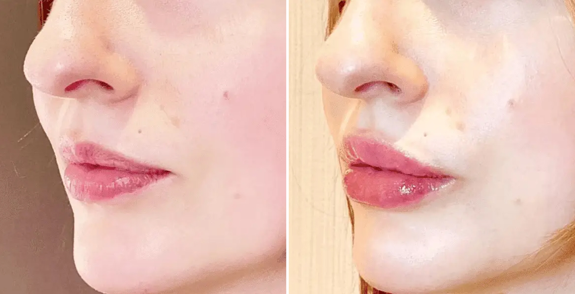 woman's lips before and after lip filler injection treatment at SKINNEY Medspa NYC