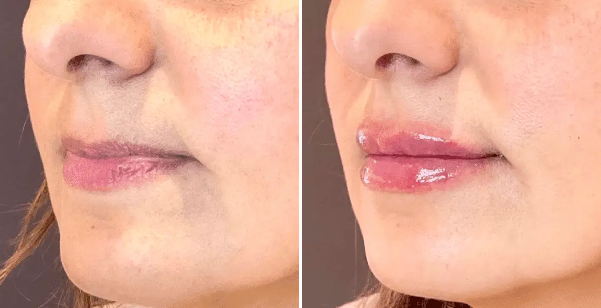 Woman's lips before and after lip filler treatment in NYC at SKINNEY Medspa