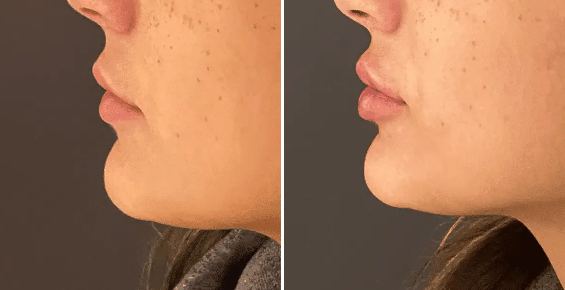 Side profile of woman's results before and after lip fillers NYC treatment