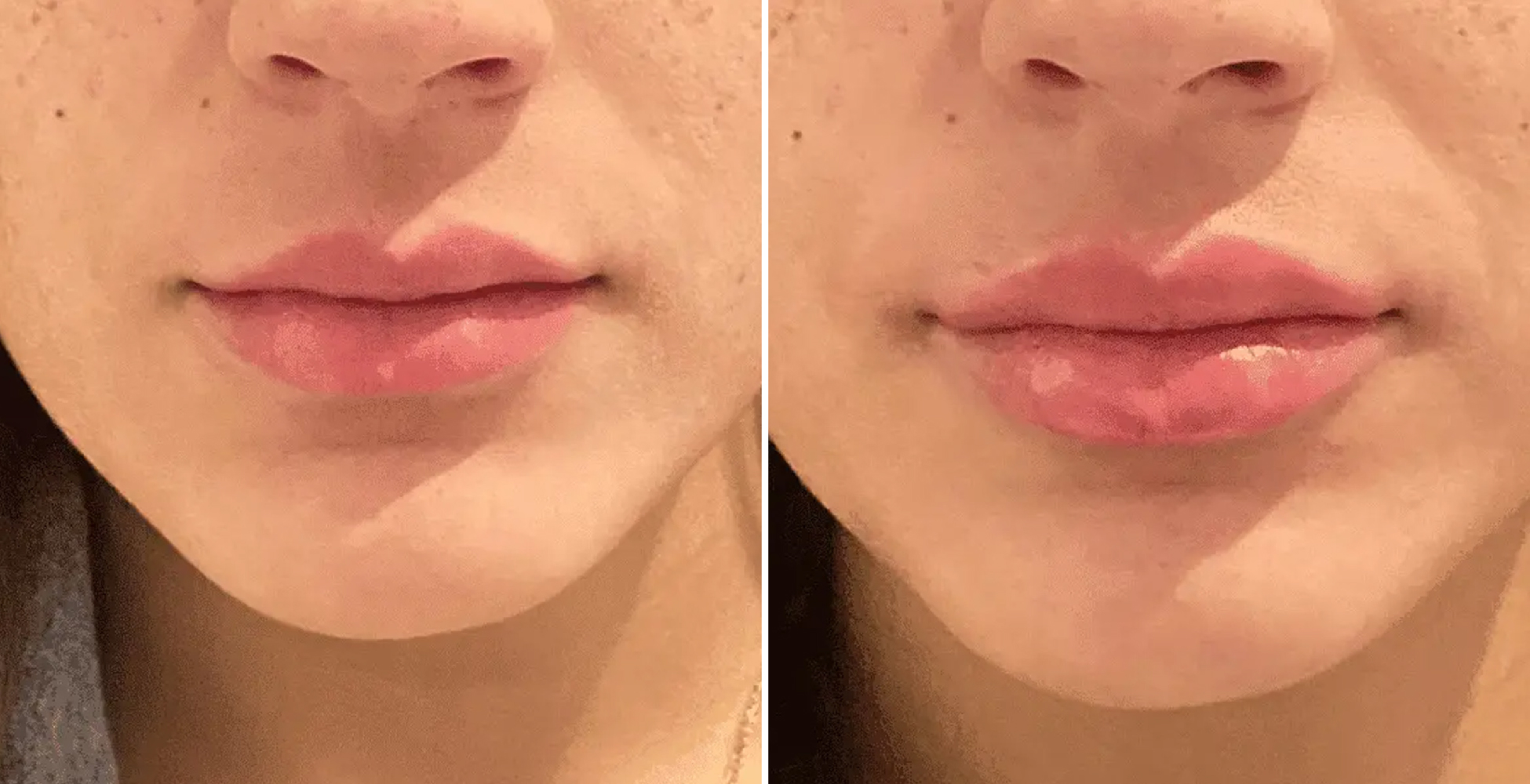 Woman's lips before and after lip filler treatment at NYC medspa